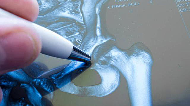 股骨颈骨折怎么才能恢复得快,股骨颈骨折一般多久可以下地负重