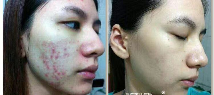脸上痘坑严重怎么治疗最好,脸上有痘坑怎么治疗最好