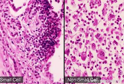 被查出肺癌一期,80岁老人肺癌晚期吃中药有效果吗
