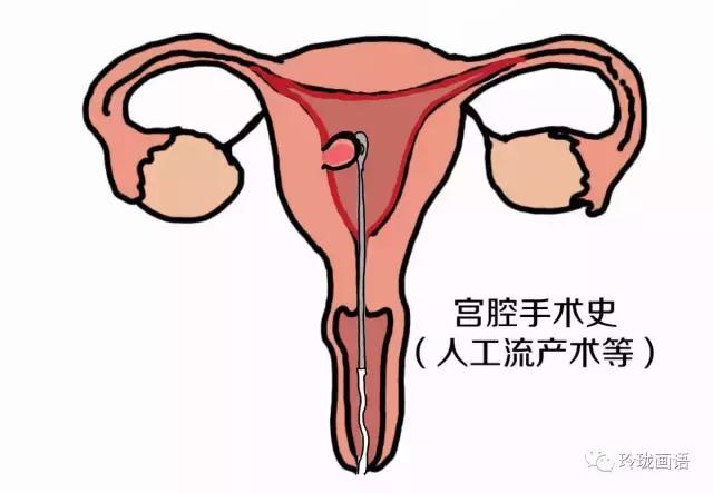 不孕和精子有关系吗,不孕主要是子宫内膜薄吗