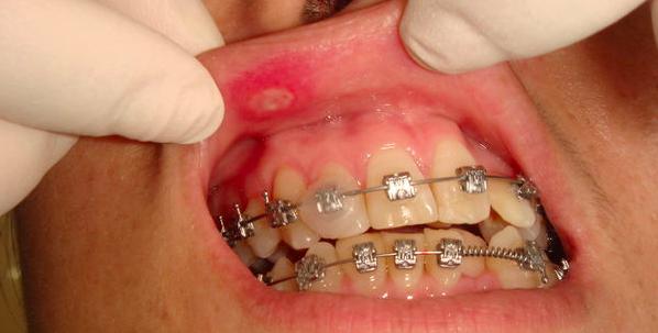 矫正牙齿后经常口腔溃疡怎么办,牙齿矫正口腔溃疡最快解决方法