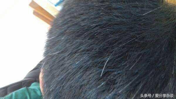 白发怎么解决,白发早生怎么办