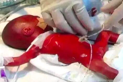 年轻妈妈产微型婴儿，花几十万也保不住，医生大怒：你们干的好事