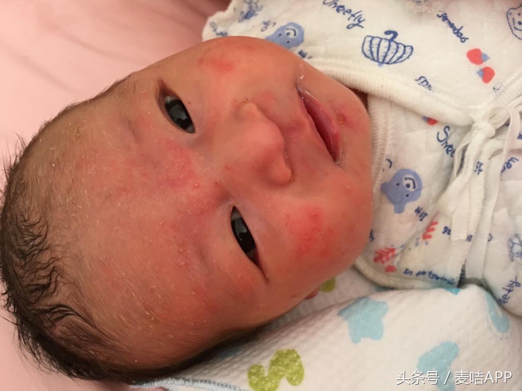 宝宝湿疹非激素药膏,婴儿湿疹多大就不再复发了