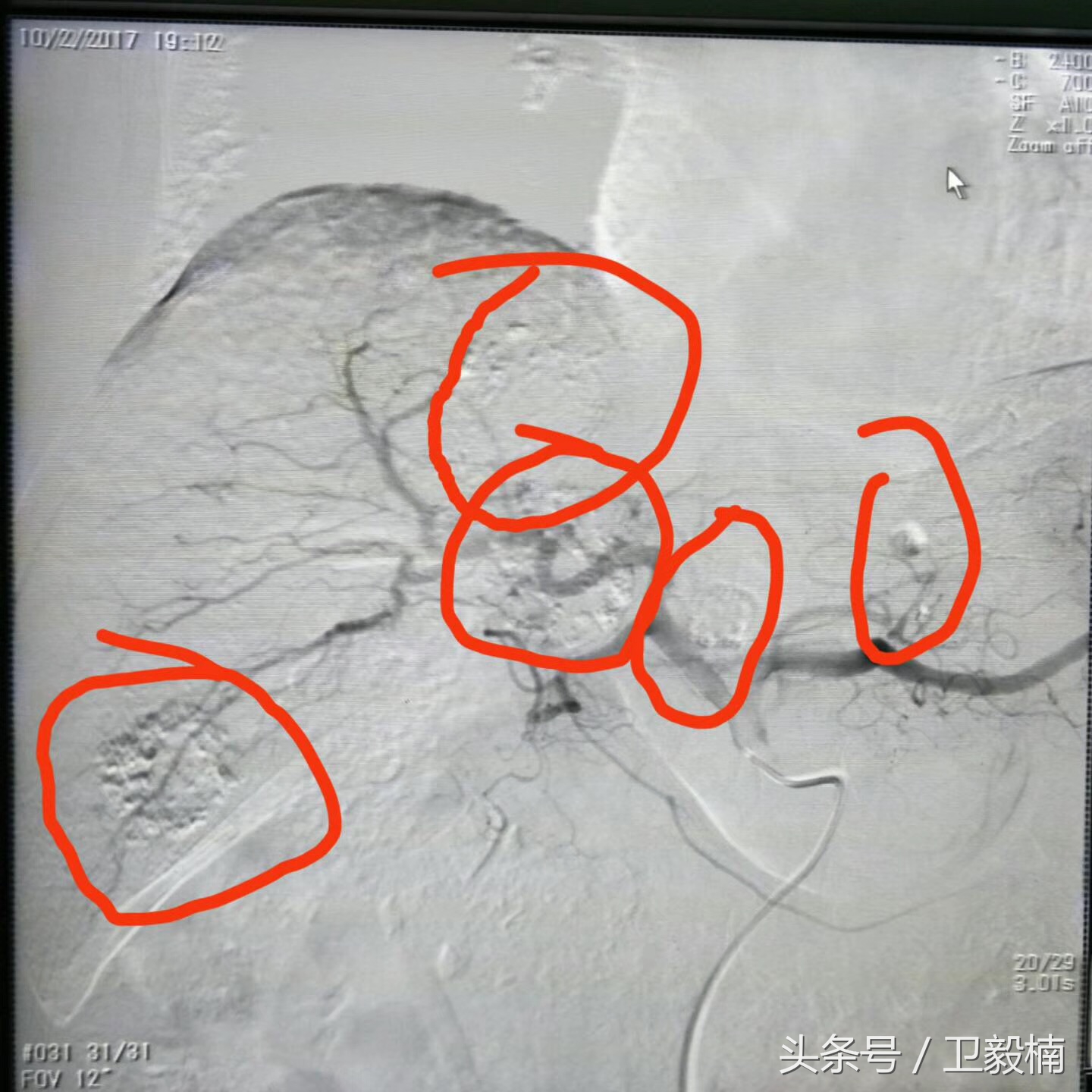 微创介入科一卫毅楠,卫毅楠运城介入治疗