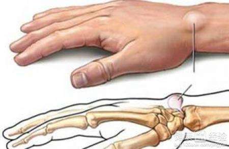 切除脂肪瘤手术要大概多少钱,乳房脂肪瘤有什么危害需要切除吗