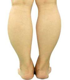 小腿粗如何改善走姿,两个小腿不一样粗怎么改善