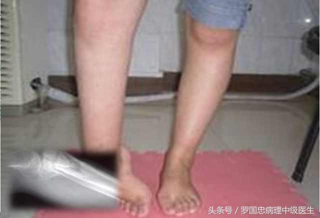 骨髓炎中药验方,骨髓炎医案