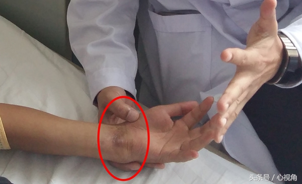 手腕骨折后畸形怎么治,骨折后外敷中药脱皮