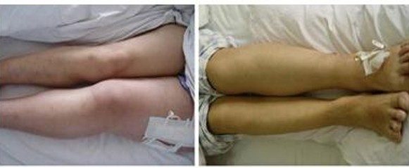 孕期下肢水肿很正常,孕期水肿右腿比左腿严重