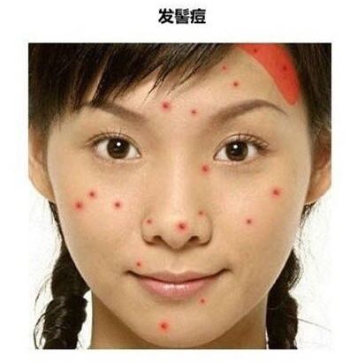 看图识别痘痘,看懂各种痘痘类型和应对方法