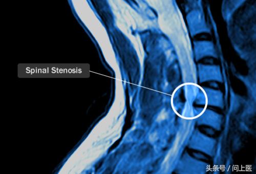 颈部疾病怎么护理,颈部疾病病人的护理