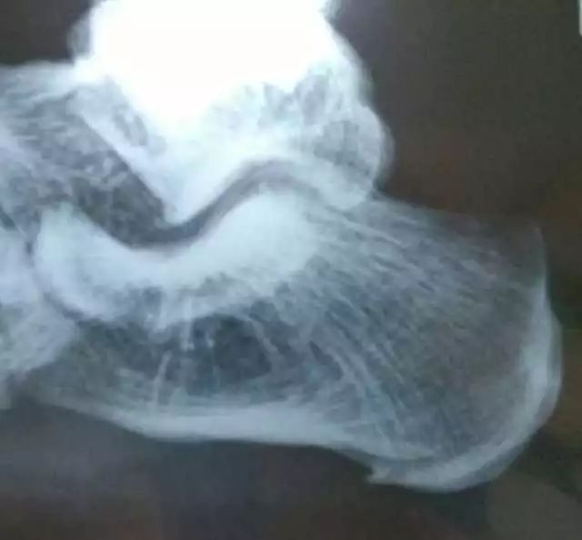 打羽毛球造成网球肘的原因,打羽毛球网球肘最快的自愈方法