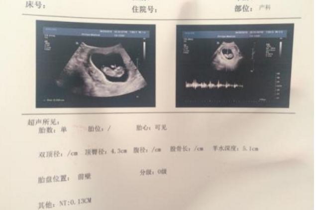 nt是唐筛吗唐筛几周做,nt和早期唐筛都过中期唐筛没过