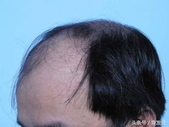 硫磺膏洗头发对脂溢性脱发的帮助,脂溢性脱发可以用二硫化硒洗头吗