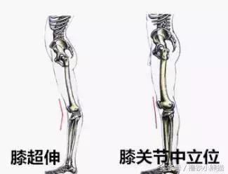 腿粗又有膝超伸该怎么改正,膝超伸为什么腿会粗
