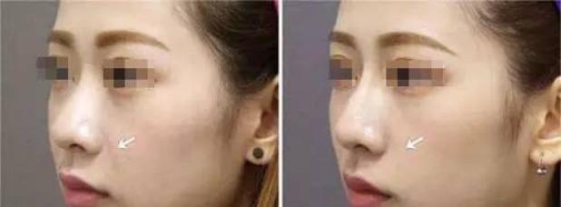 超声刀多久能出效果,超声刀多久做一次