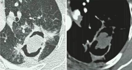 《慢性肺曲霉病：诊断和治疗的理论基础及临床指南》解读