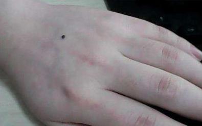 手背长痣的女人有什么特征,手背有痣的女人右手