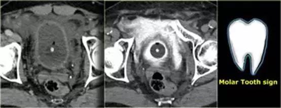 腹腔脏器炎症ct可以查出来吗,膀胱创伤的诊断方法