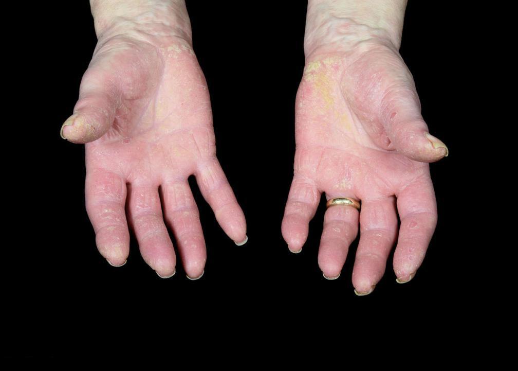 关节型银屑病的鉴别诊断,关节病性银屑病诊断标准