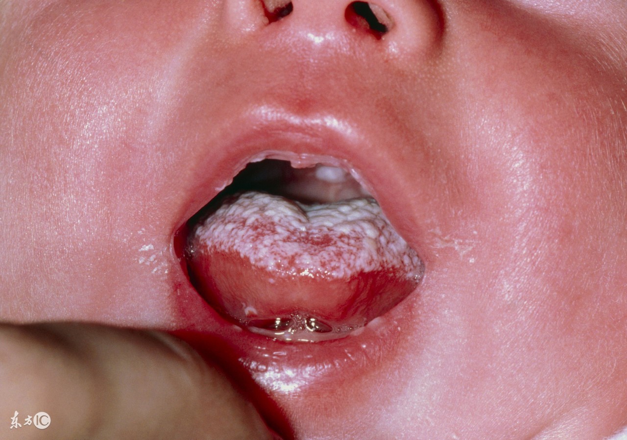 鹅口疮引起败血症,鹅口疮容易引起败血症吗