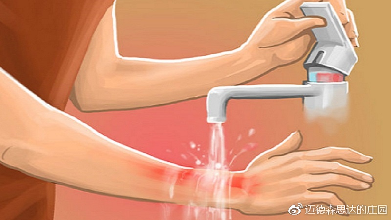 烧伤怎么正确用药,烧伤时最重要的急救方法是