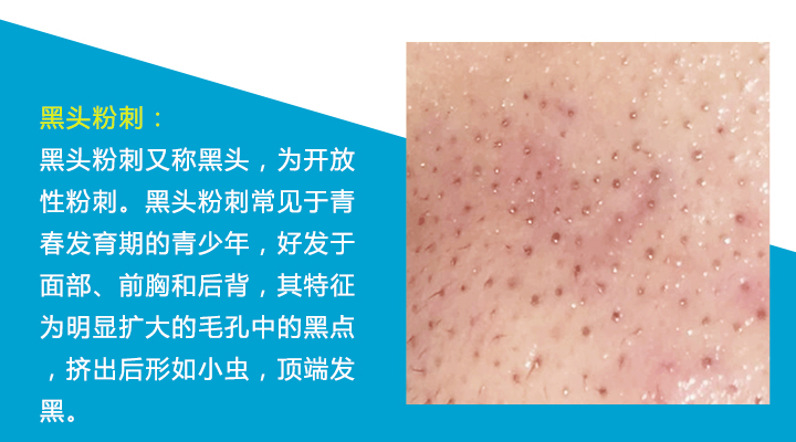 八种痘痘,九大部位的痘痘