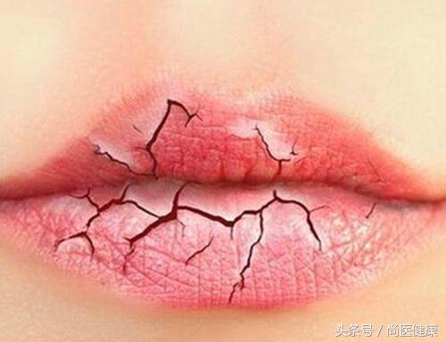 嘴唇太干起皮怎么解决用什么唇膏,嘴唇太干有什么妙招解决