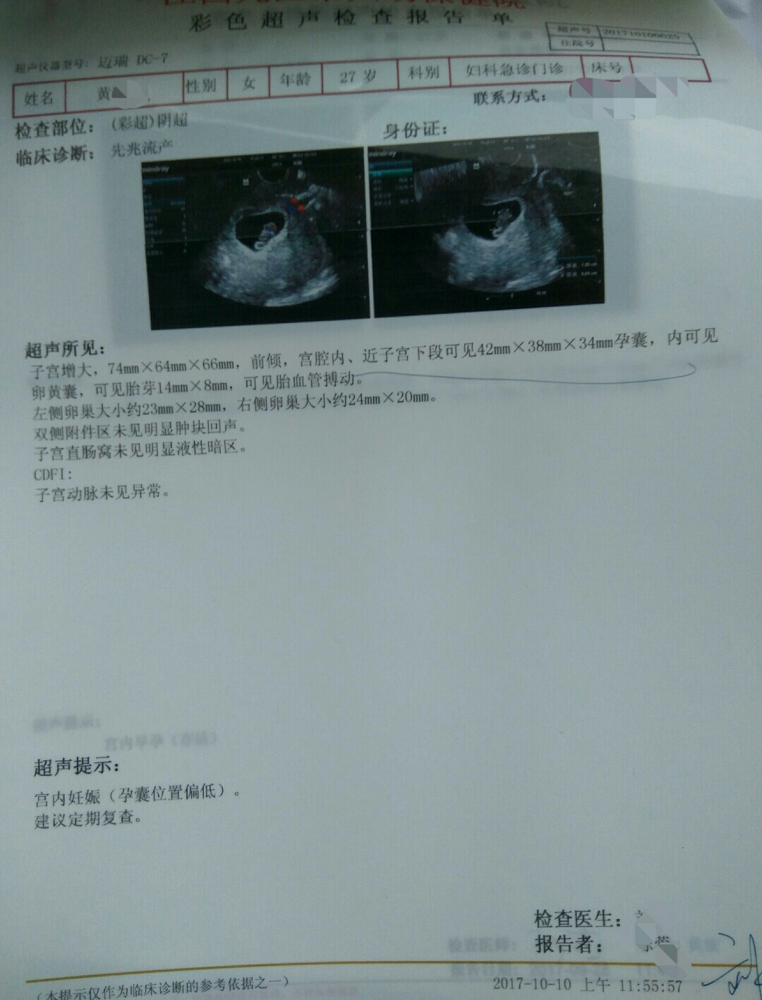 保胎过程中孕酮hcg还降了,孕酮低保胎真实感受