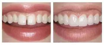 缺了一颗大牙牙齿缝隙越来越大,牙齿缝隙越来越大中医辨证