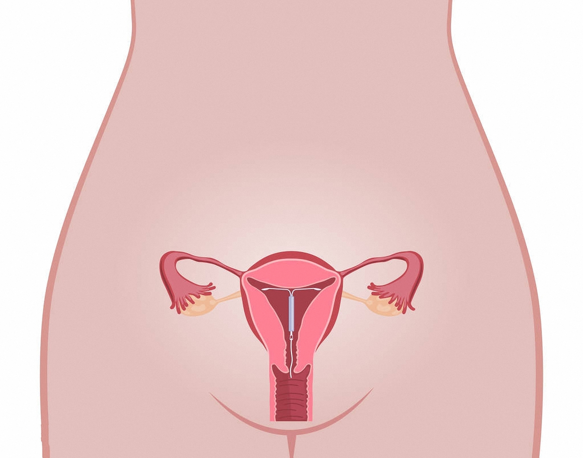 女用避孕环百分百避孕吗,宫颈癌患者避孕环能取么