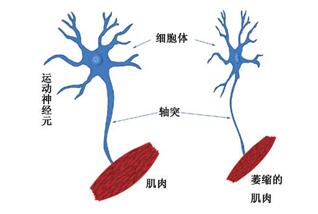 股骨头坏死有麻木的感觉,股骨头坏死会导致屁股麻木吗