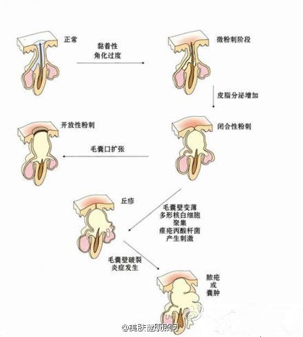 闭合性粉刺怎么用角质铲清,闭合性粉刺可以用去角质产品去掉