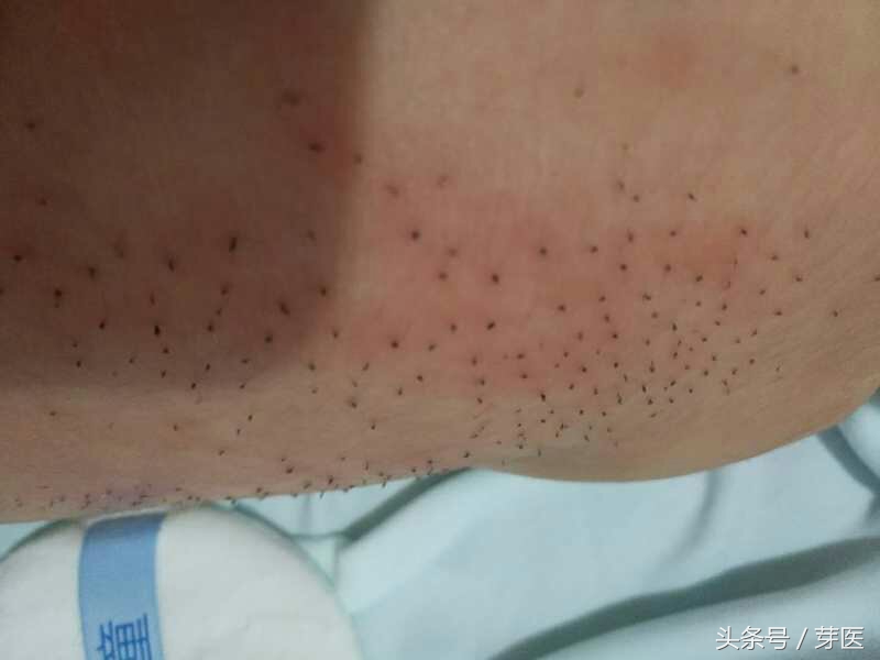 什么是猪毛疯,医学上说猪毛疯是什么病