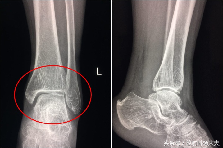 踝关节骨性关节炎变形严重,踝关节骨性关节炎发展得快吗