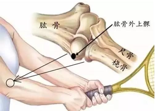 连谢霆锋都要发愁的“网球肘”是什么？有什么症状？