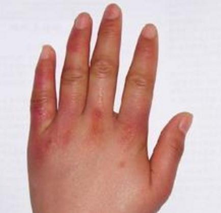 长过冻疮的手都会粗一圈，而且每年都会复发，7个小窍门杜绝复发