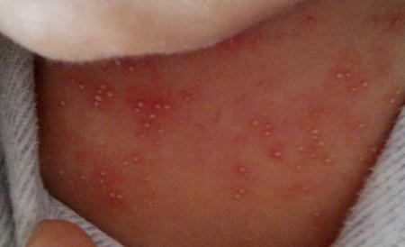 婴儿脸上疹子,婴儿疹子