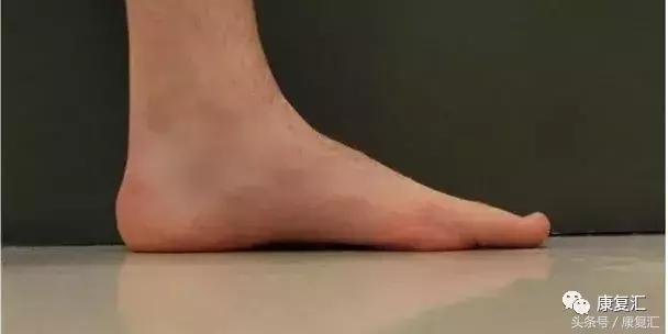 踝关节扭伤正确处理方法是,董氏奇穴治疗踝关节扭伤