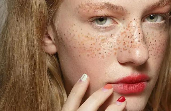 各种斑的特点区别,16种斑如何分析鉴别