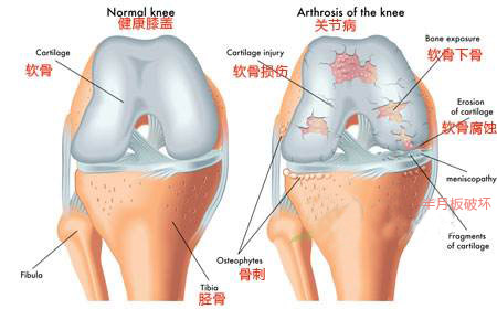 骨病分为骨质疏松和骨关节炎,骨质增生关节炎是什么症状