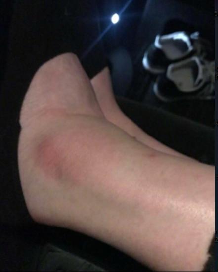 维密秀摔倒事件,维密超模走秀崴脚