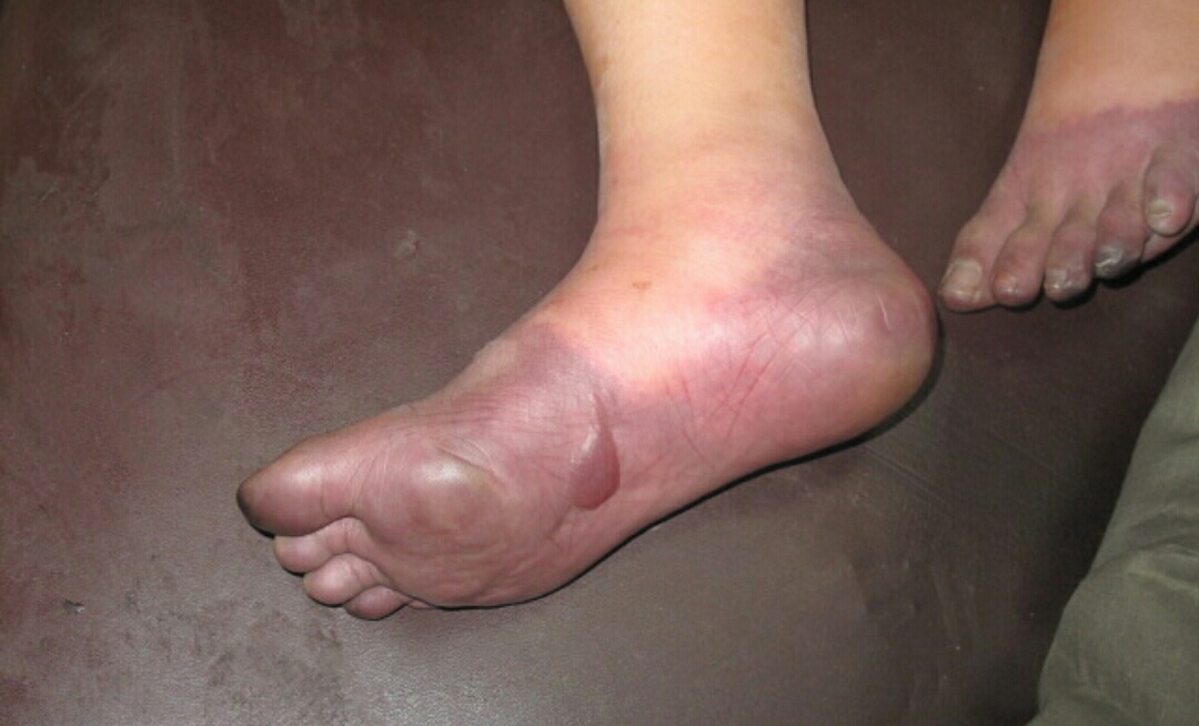 冻伤疮最佳治疗方案,冻伤疮什么意思