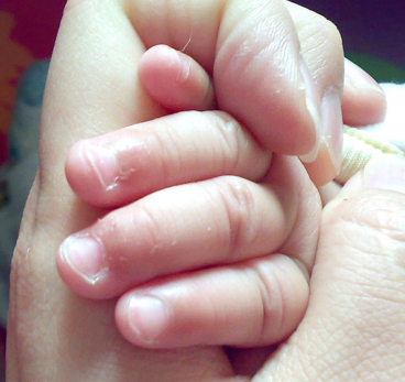 宝宝手上长倒刺脱皮缺什么,宝宝手起疹子皲裂