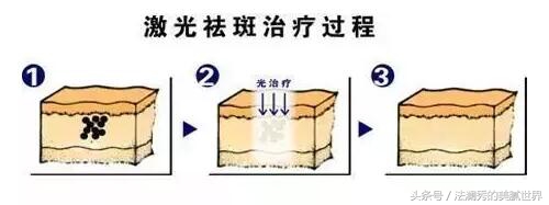 祛斑成功堪比整容,激光祛斑显老