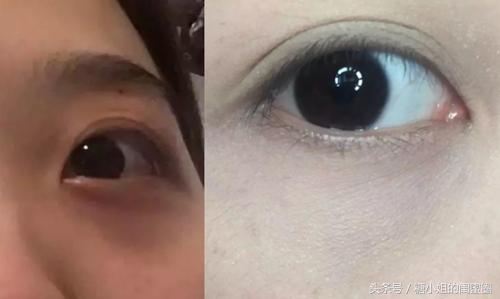 如何拯救黑眼圈眼袋,怎么拯救眼袋和泪沟