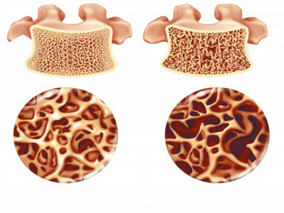 关于骨质疏松这些事你得知道,关于骨质的问题