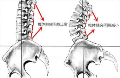 怎么判断是不是骨盆前倾矫正方法,矫正骨盆前倾的睡觉姿势
