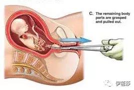 无痛人流3次会不孕吗,无痛人流花了快6千感觉被骗了